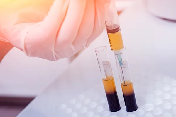 PRP orthopedic syringe preparation from tubes of platelet rich plasma